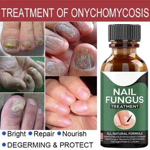 ⭐⭐⭐⭐⭐ (350+ Reviews) 🌿 Fast Nail Fungal Treatment – 💅 Nail Repair Essence Serum | Foot & Hand Fungus Removal Gel